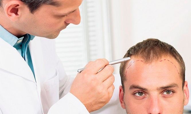 Calificación Intermedio Saca la aseguranza La caída de cabello, también llamada alopecia | Dermatologia-us